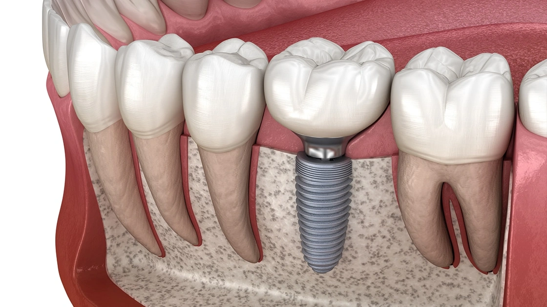 implant service graphic image