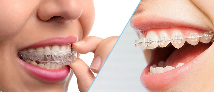Invisalign and clearcorrect image